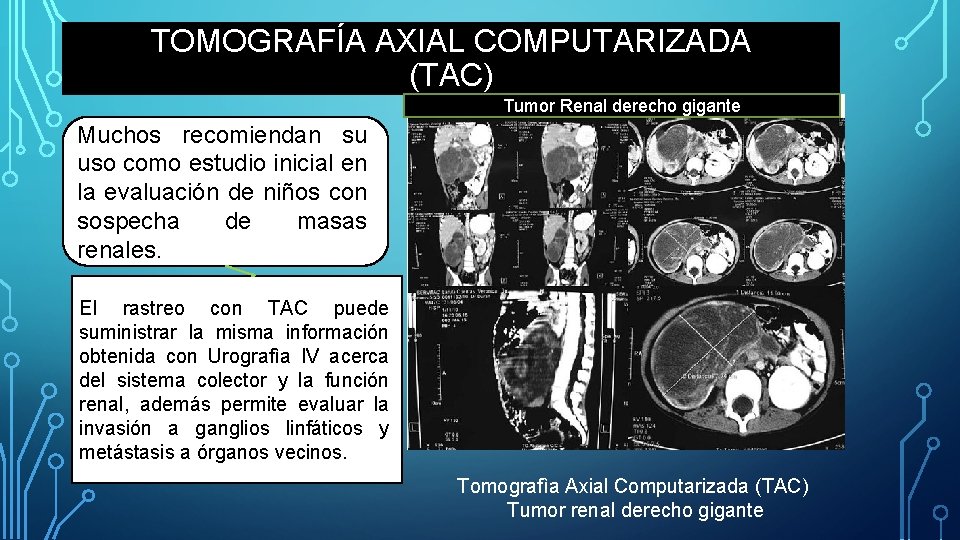 TOMOGRAFÍA AXIAL COMPUTARIZADA (TAC) Tumor Renal derecho gigante Muchos recomiendan su uso como estudio