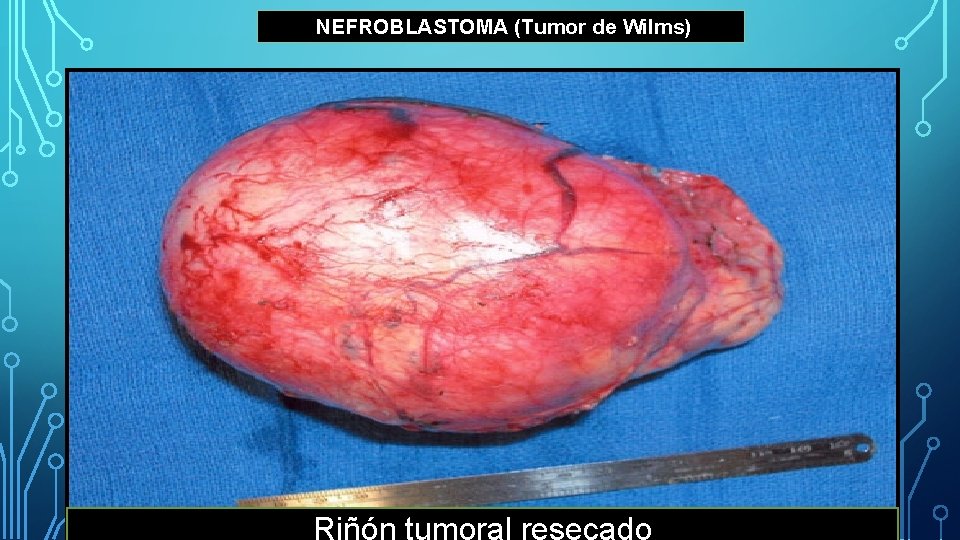 NEFROBLASTOMA (Tumor de Wilms) Riñón tumoral resecado 