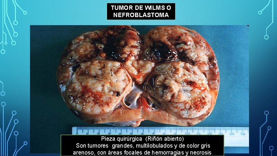 TUMOR DE WILMS O NEFROBLASTOMA Pieza quirúrgica (Riñón abierto) Son tumores grandes, multilobulados y