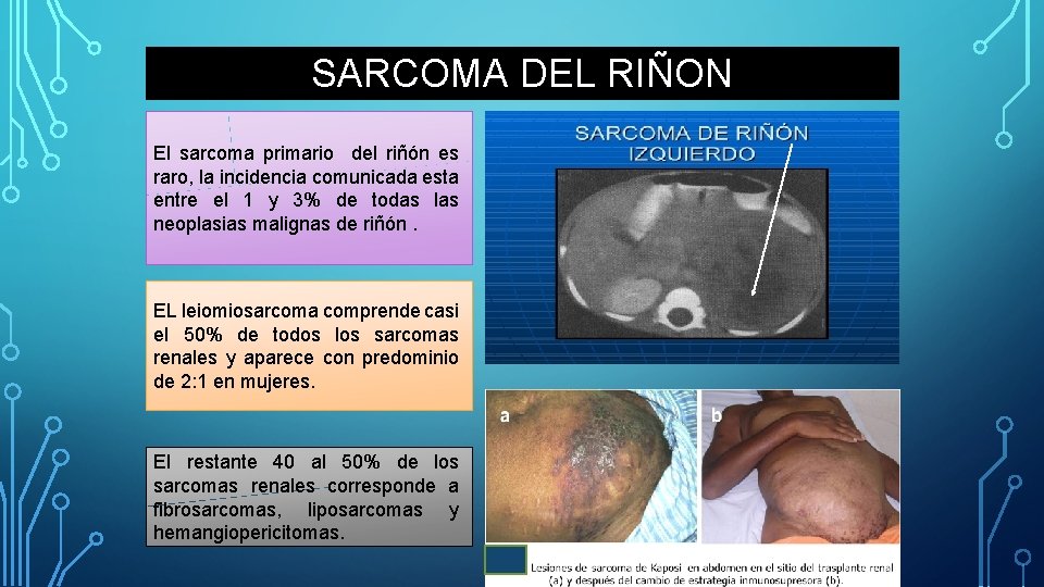 SARCOMA DEL RIÑON El sarcoma primario del riñón es raro, la incidencia comunicada esta