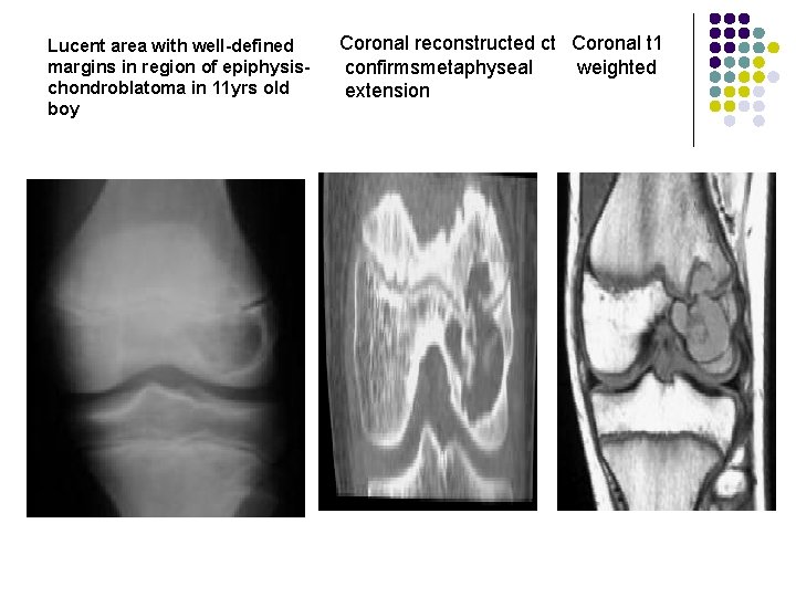 Lucent area with well-defined margins in region of epiphysischondroblatoma in 11 yrs old boy