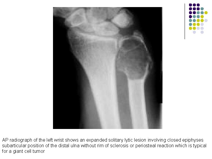 AP radiograph of the left wrist shows an expanded solitary lytic lesion involving closed
