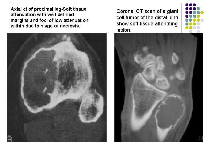 Axial ct of proximal leg-Soft tissue attenuation with well defined margins and foci of