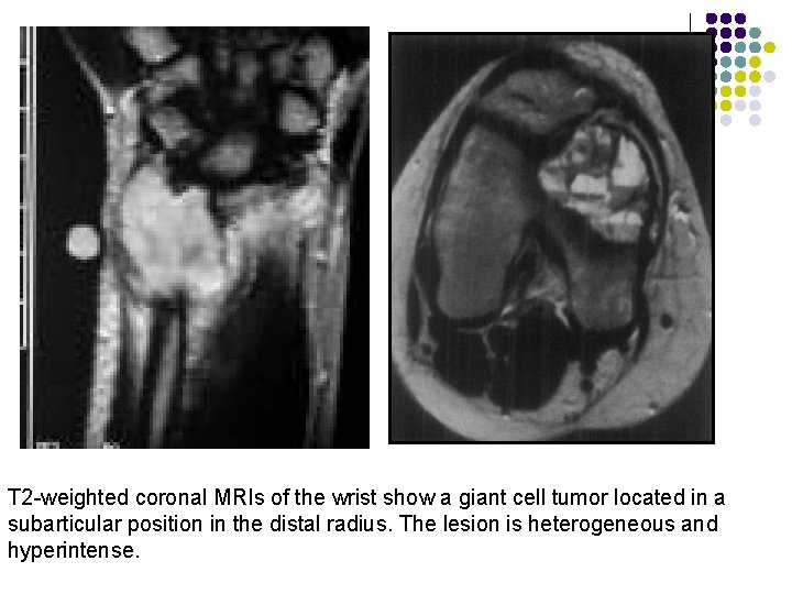 T 2 -weighted coronal MRIs of the wrist show a giant cell tumor located