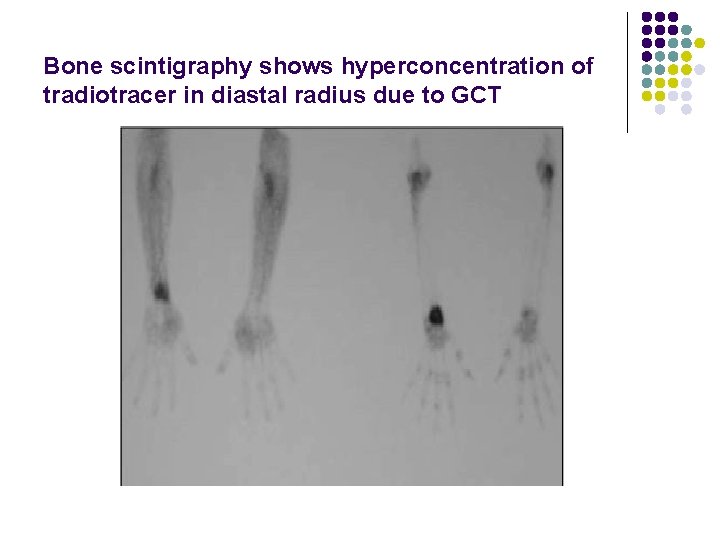 Bone scintigraphy shows hyperconcentration of tradiotracer in diastal radius due to GCT 