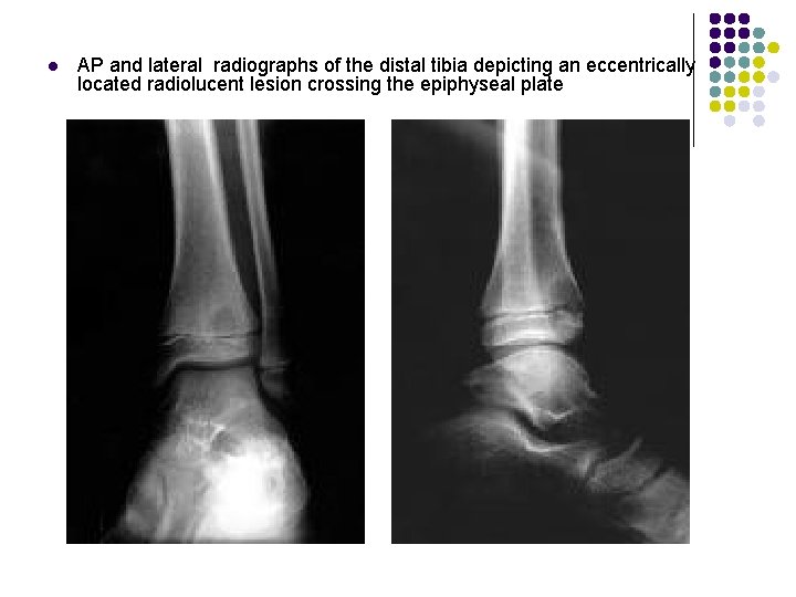 l AP and lateral radiographs of the distal tibia depicting an eccentrically located radiolucent