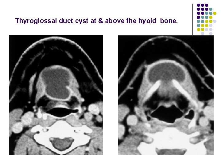 Thyroglossal duct cyst at & above the hyoid bone. 