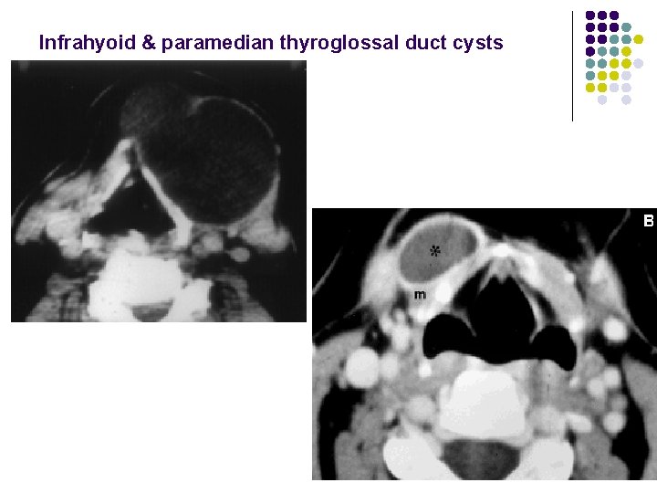 Infrahyoid & paramedian thyroglossal duct cysts 