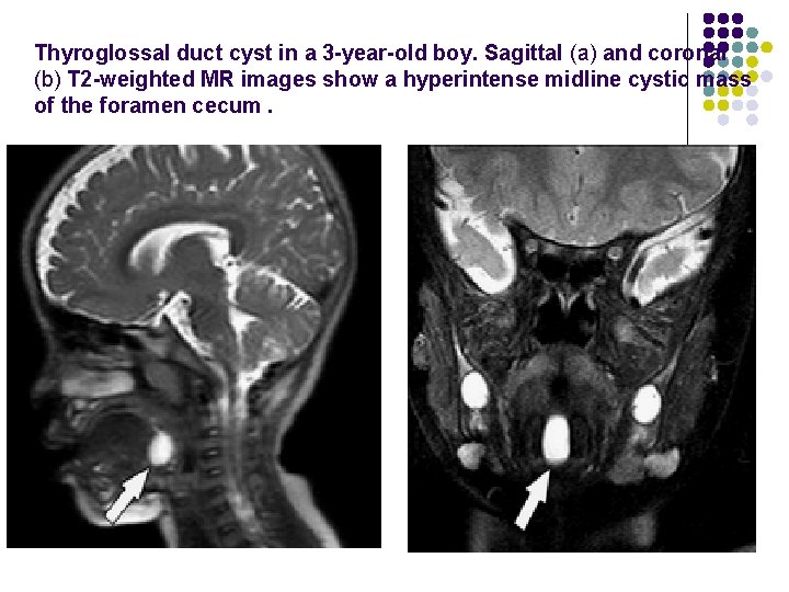 Thyroglossal duct cyst in a 3 -year-old boy. Sagittal (a) and coronal (b) T