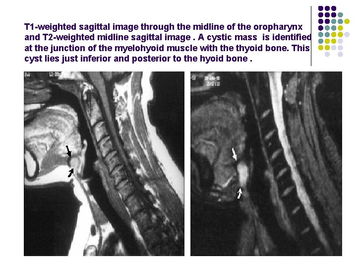 T 1 -weighted sagittal image through the midline of the oropharynx and T 2