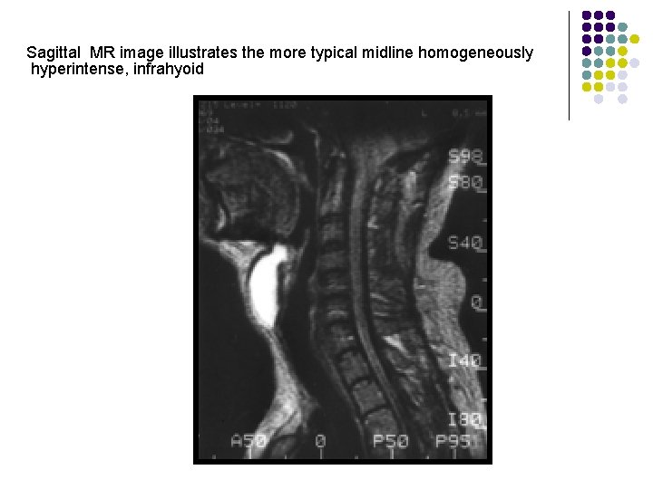 Sagittal MR image illustrates the more typical midline homogeneously hyperintense, infrahyoid 