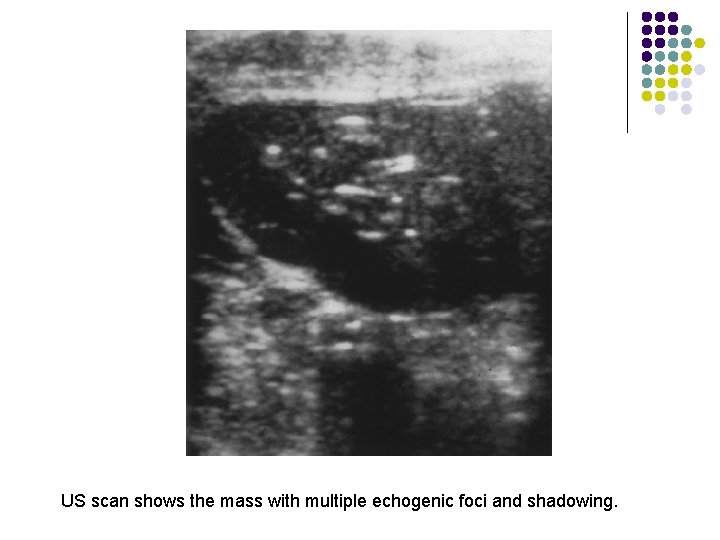 US scan shows the mass with multiple echogenic foci and shadowing. 