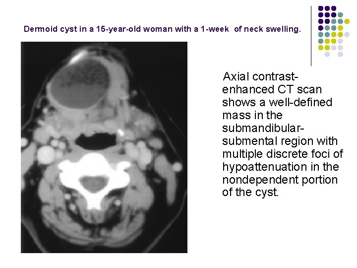 Dermoid cyst in a 15 -year-old woman with a 1 -week of neck swelling.