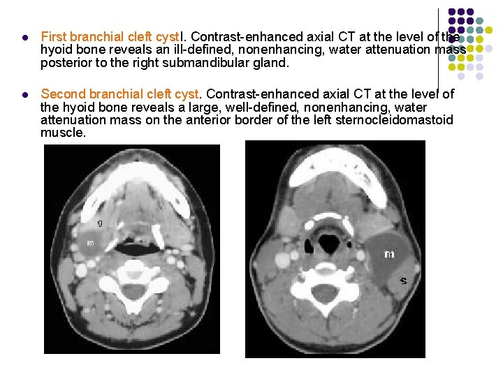 l First branchial cleft cyst. I. Contrast-enhanced axial CT at the level of the
