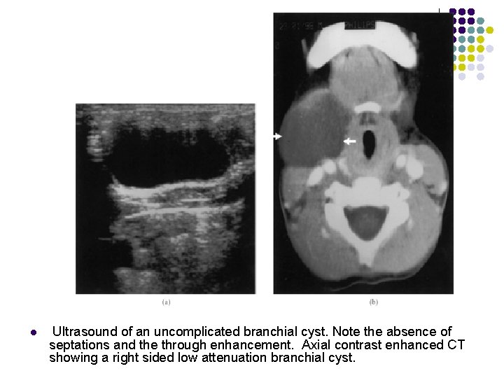 l Ultrasound of an uncomplicated branchial cyst. Note the absence of septations and the