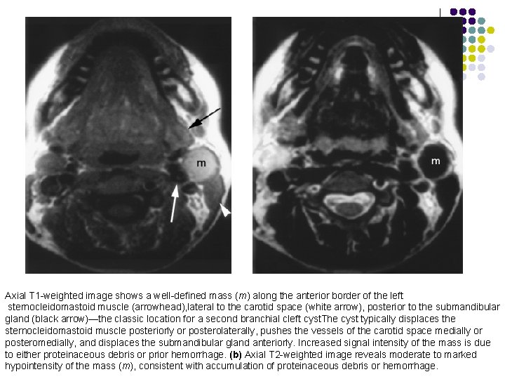 Axial T 1 -weighted image shows a well-defined mass (m) along the anterior border