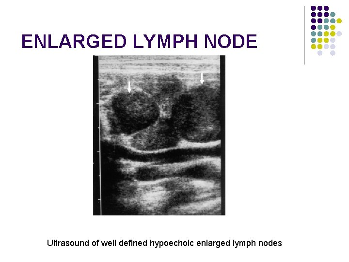ENLARGED LYMPH NODE Ultrasound of well defined hypoechoic enlarged lymph nodes 
