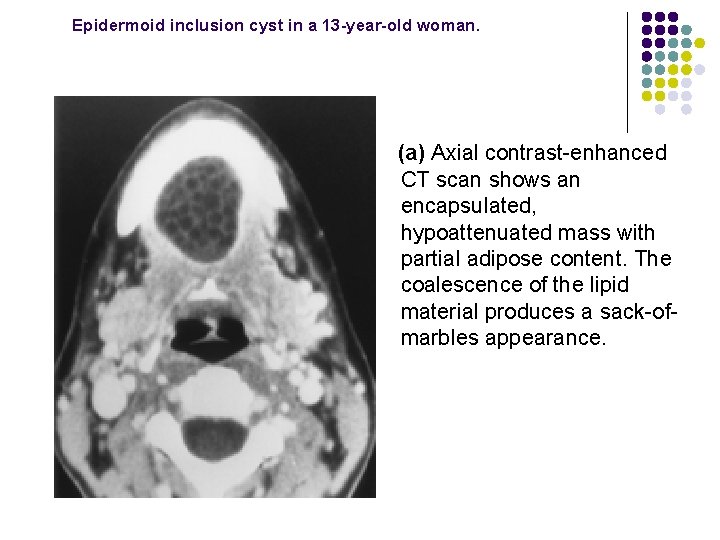 Epidermoid inclusion cyst in a 13 -year-old woman. (a) Axial contrast-enhanced CT scan shows