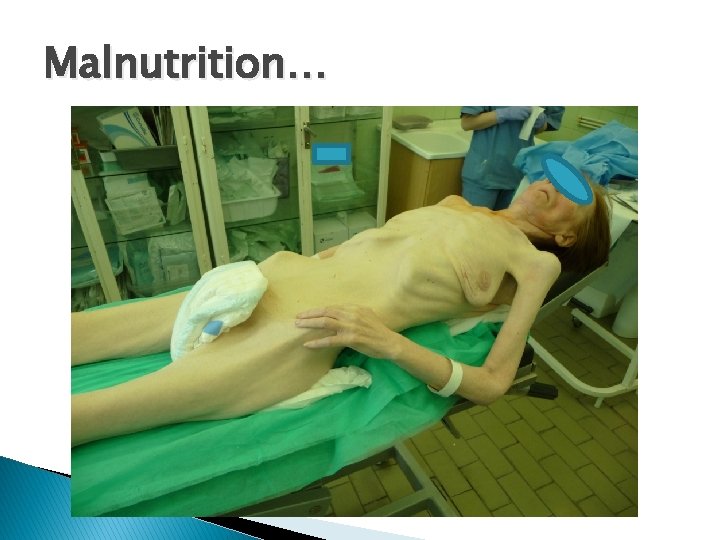 Malnutrition… 