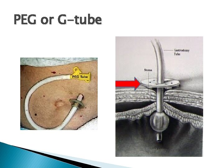 PEG or G-tube 