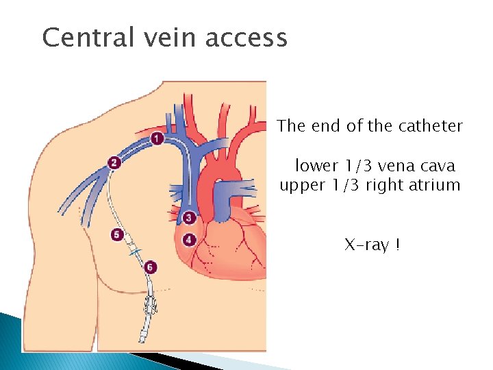 Central vein access The end of the catheter lower 1/3 vena cava upper 1/3