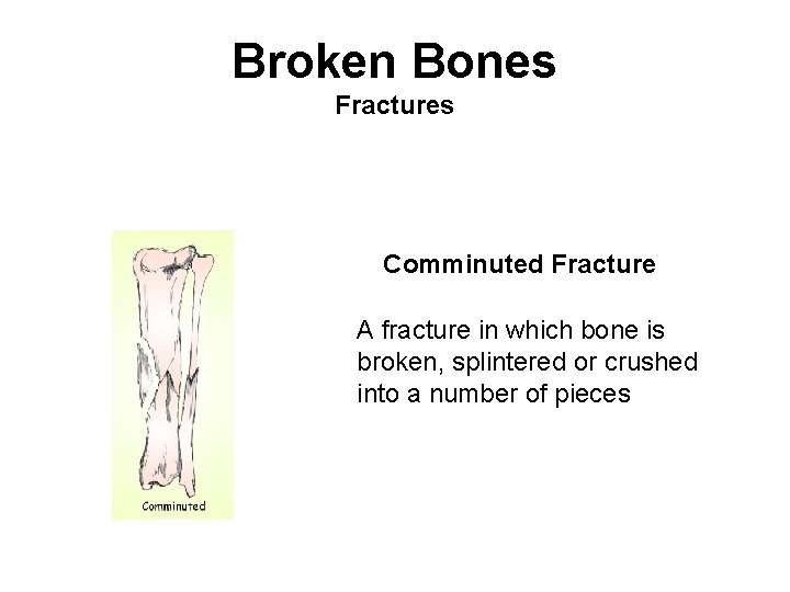 Broken Bones Fractures Comminuted Fracture A fracture in which bone is broken, splintered or