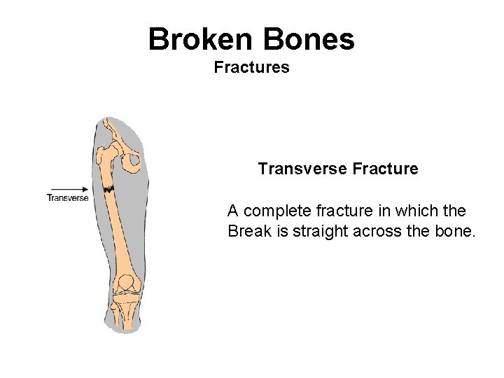 Broken Bones Fractures Transverse Fracture A complete fracture in which the Break is straight