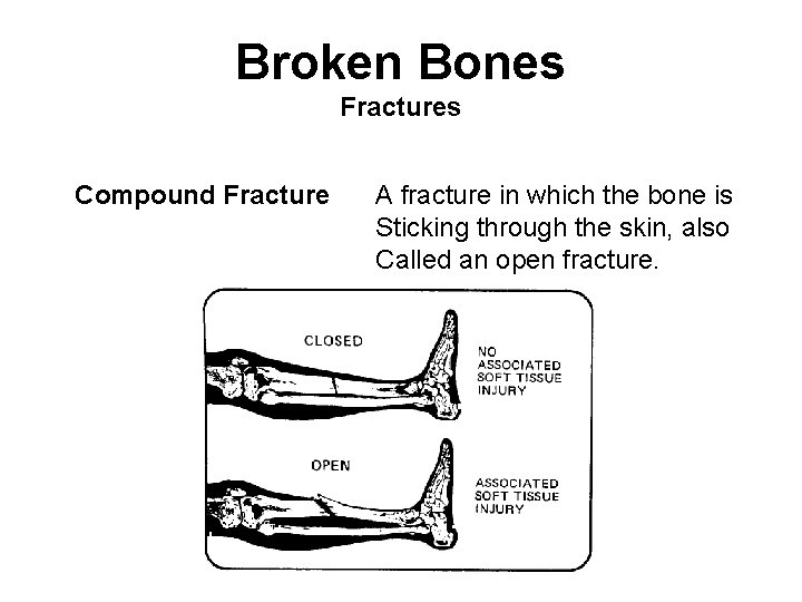Broken Bones Fractures Compound Fracture A fracture in which the bone is Sticking through