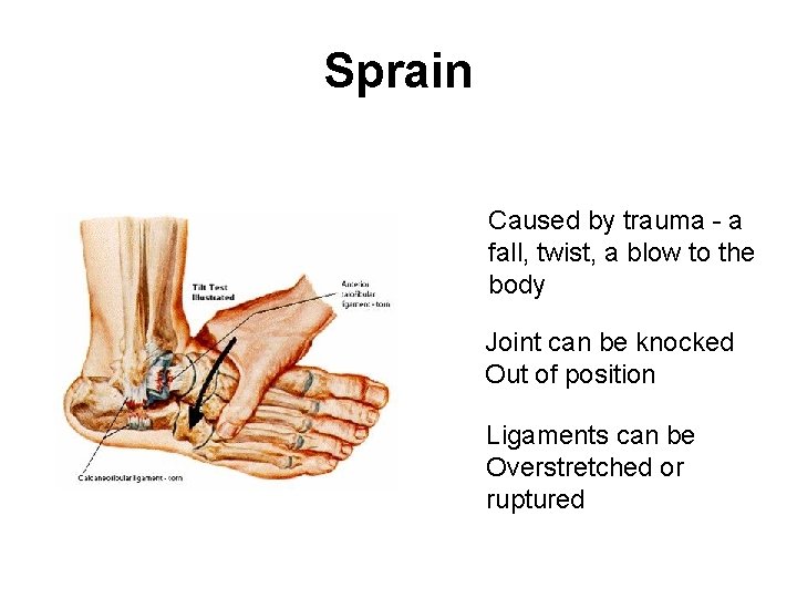 Sprain Caused by trauma - a fall, twist, a blow to the body Joint