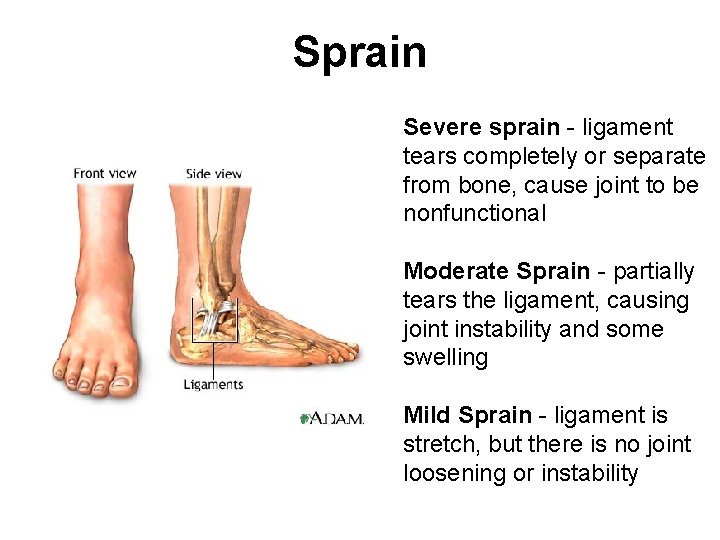 Sprain Severe sprain - ligament tears completely or separate from bone, cause joint to