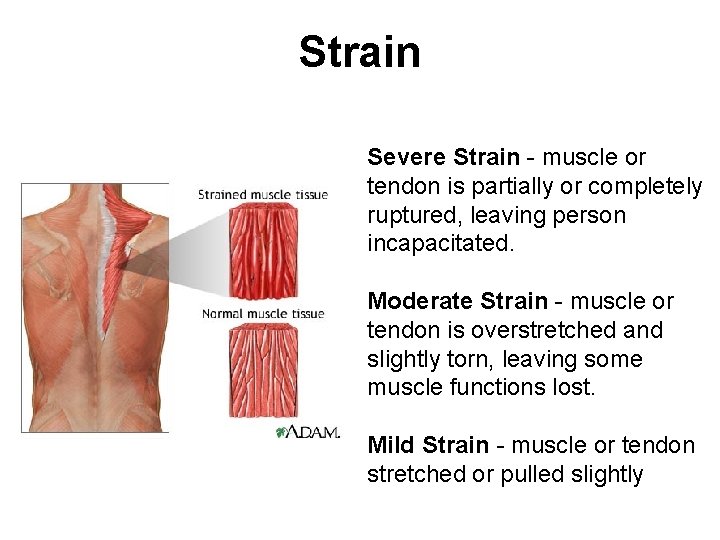 Strain Severe Strain - muscle or tendon is partially or completely ruptured, leaving person