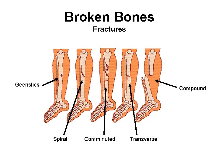 Broken Bones Fractures Geenstick Compound Spiral Comminuted Transverse 