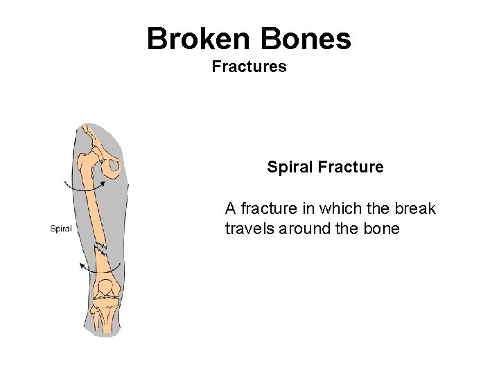 Broken Bones Fractures Spiral Fracture A fracture in which the break travels around the