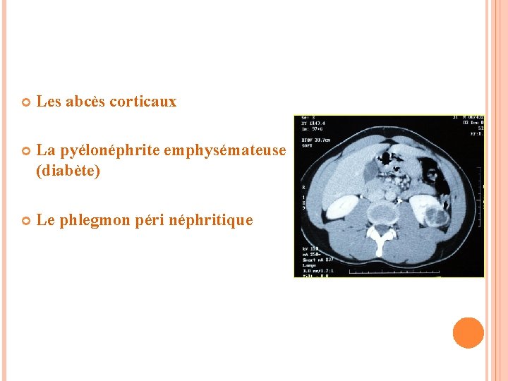  Les abcès corticaux La pyélonéphrite emphysémateuse (diabète) Le phlegmon péri néphritique 