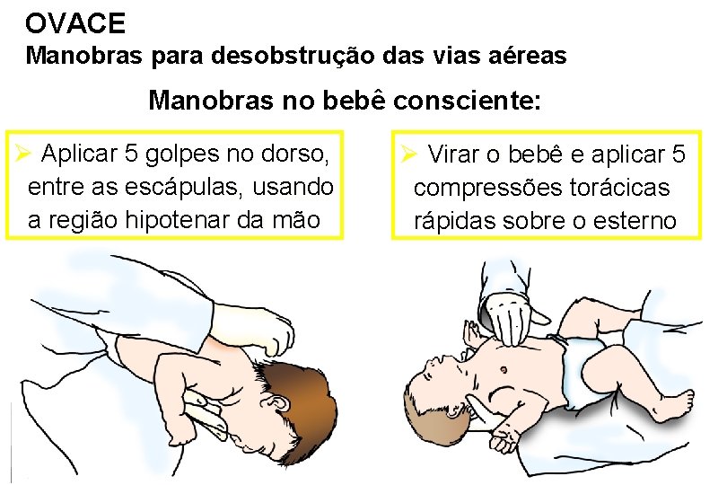 OVACE Manobras para desobstrução das vias aéreas Manobras no bebê consciente: Ø Aplicar 5
