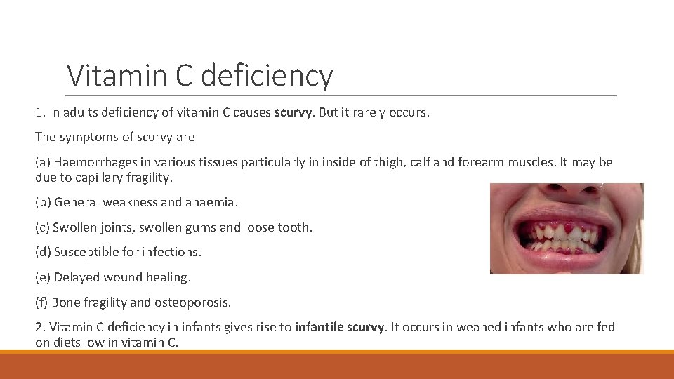 Vitamin C deficiency 1. In adults deficiency of vitamin C causes scurvy. But it