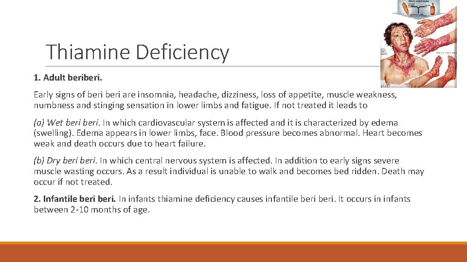 Thiamine Deficiency 1. Adult beri. Early signs of beri are insomnia, headache, dizziness, loss