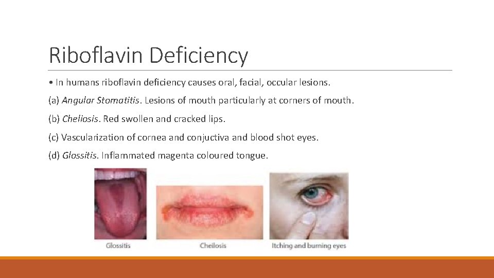 Riboflavin Deficiency • In humans riboflavin deficiency causes oral, facial, occular lesions. (a) Angular