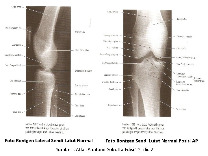 Foto Rontgen Lateral Sendi Lutut Normal Foto Rontgen Sendi Lutut Normal Posisi AP Sumber