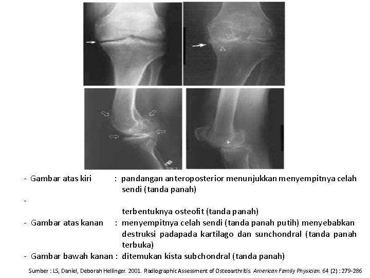 - Gambar atas kiri - : pandangan anteroposterior menunjukkan menyempitnya celah sendi (tanda panah)