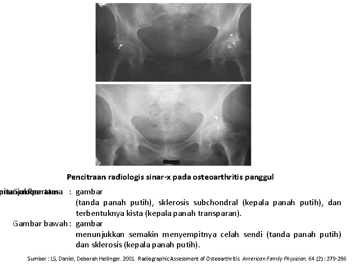 Pencitraan radiologis sinar-x pada osteoarthritis panggul enunjukkan pitan Gambar pertama atas : gambar (tanda