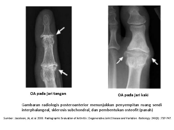 OA pada jari tangan OA pada jari kaki Gambaran radiologis posteroanterior menunjukkan penyempitan ruang