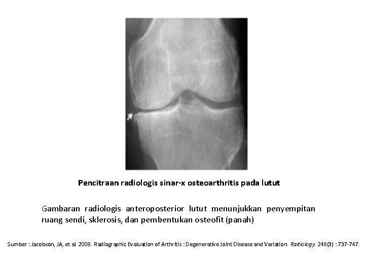 Pencitraan radiologis sinar-x osteoarthritis pada lutut Gambaran radiologis anteroposterior lutut menunjukkan penyempitan ruang sendi,