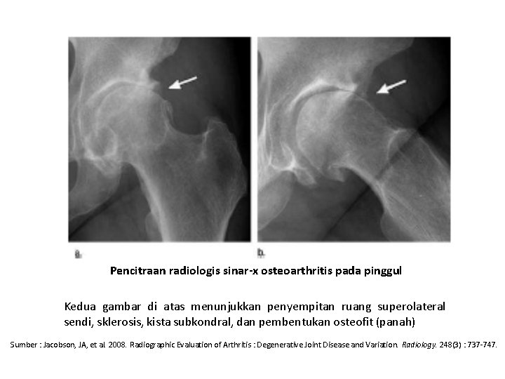 Pencitraan radiologis sinar-x osteoarthritis pada pinggul Kedua gambar di atas menunjukkan penyempitan ruang superolateral