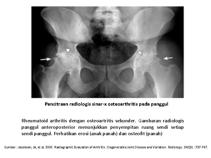 Pencitraan radiologis sinar-x osteoarthritis pada panggul Rheumatoid arthritis dengan osteoartritis sekunder. Gambaran radiologis panggul