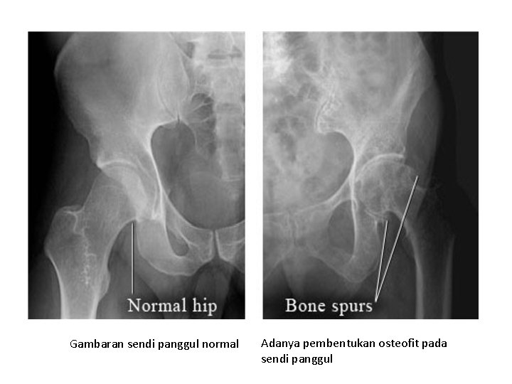 Gambaran sendi panggul normal Adanya pembentukan osteofit pada sendi panggul 