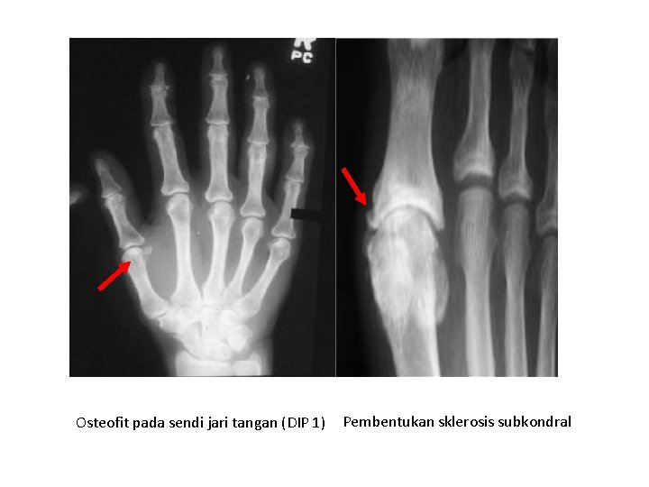 Osteofit pada sendi jari tangan (DIP 1) Pembentukan sklerosis subkondral 