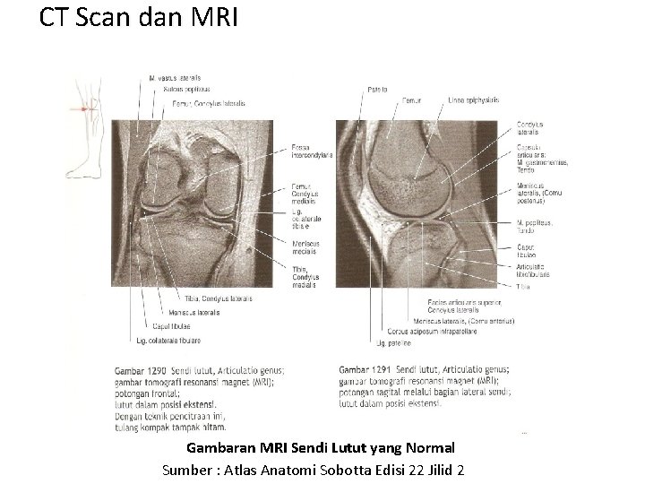 CT Scan dan MRI Gambaran MRI Sendi Lutut yang Normal Sumber : Atlas Anatomi