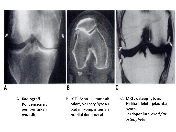 A. Radiografi Konvensional: pembentukan osteofit B. CT Scan : tampak adanya osteophytosis pada kompartemen