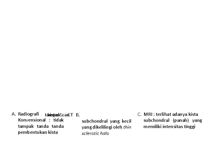 A. Radiografi tampak kista: Scan. CT B. Konvensional : tidak subchondral yang kecil tampak